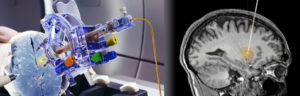 SmartFlow® Cannula - ClearPoint Neuro